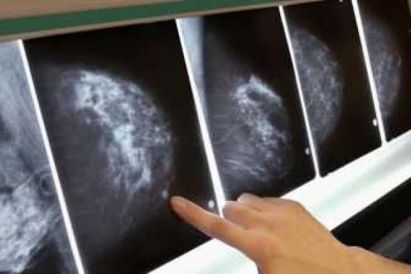 أخبار اليمن : دراسة: بعض ملوثات الهواء تزيد خطر الإصابة بسرطان الثدي